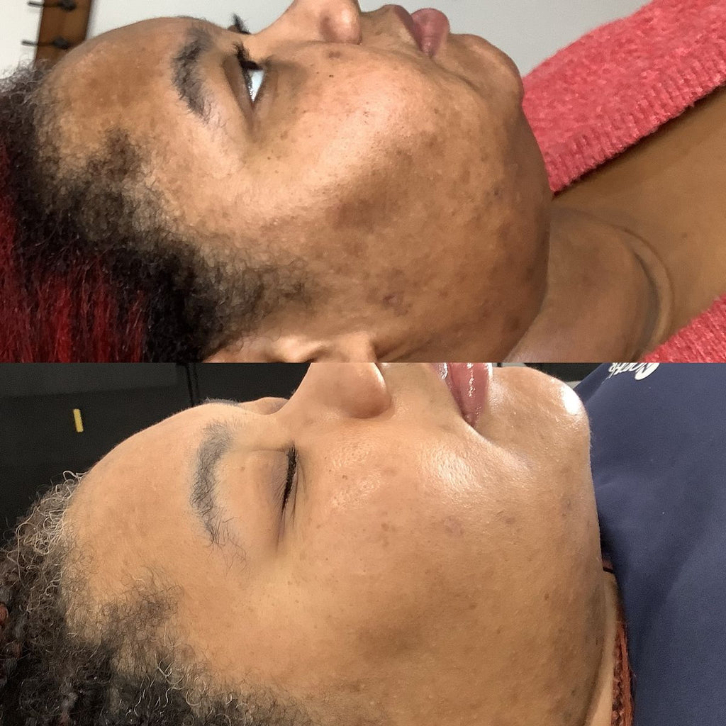 Pen M7 Microneedling