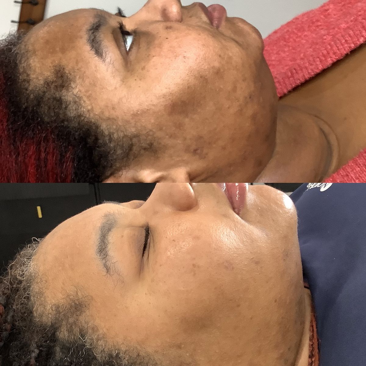 Pen M7 Microneedling