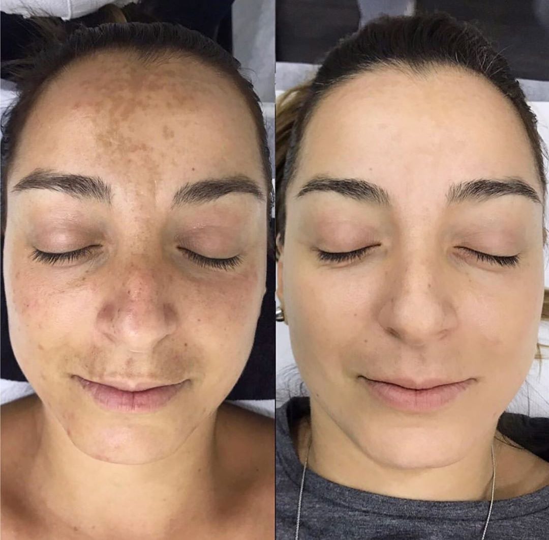 Pen M7 Microneedling