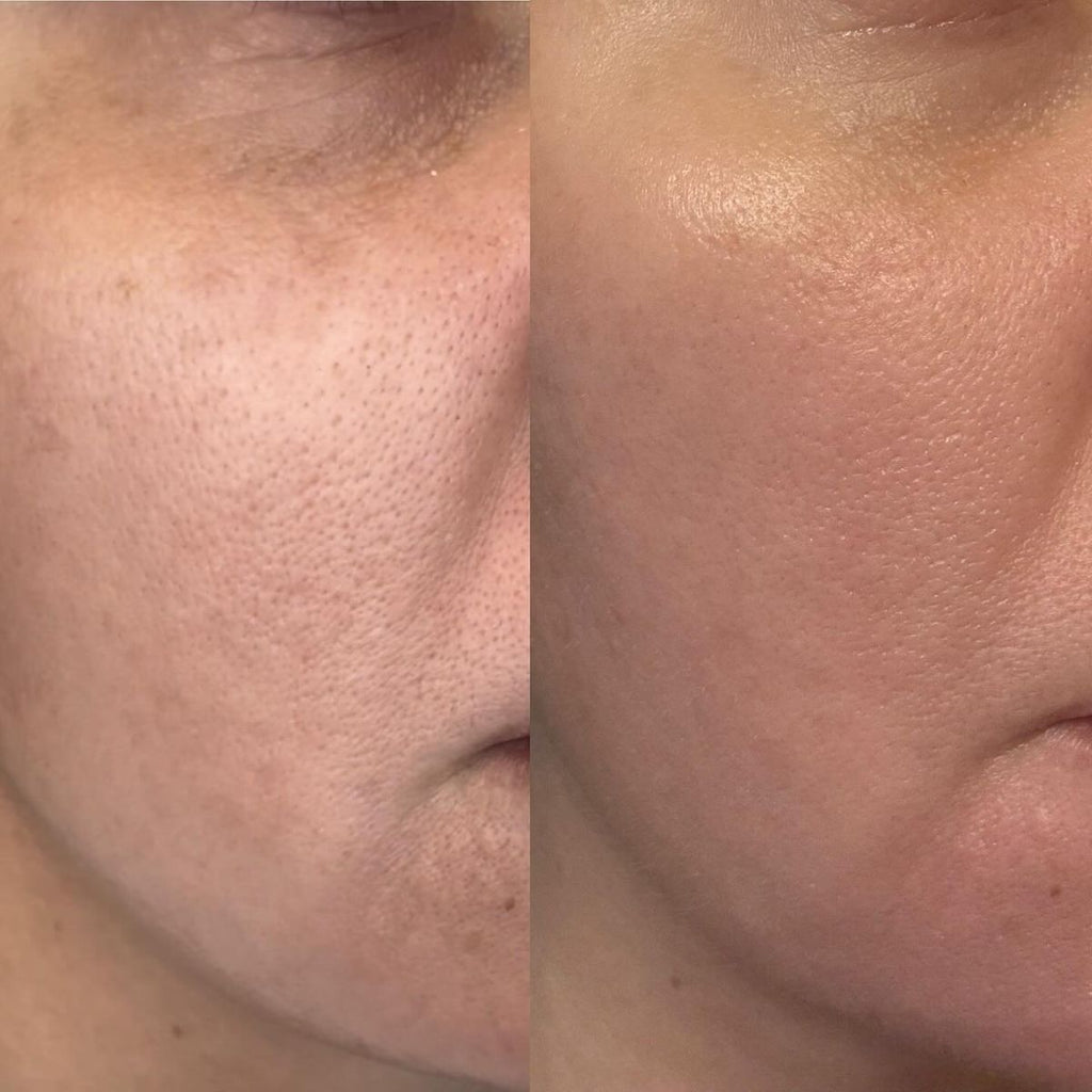 Pen M7 Microneedling