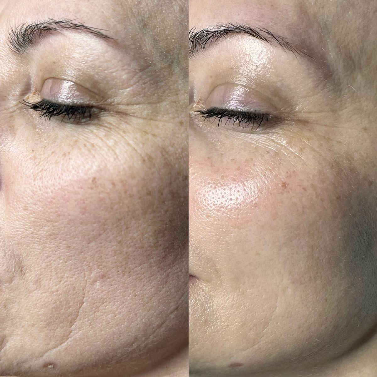 Pen M7 Microneedling